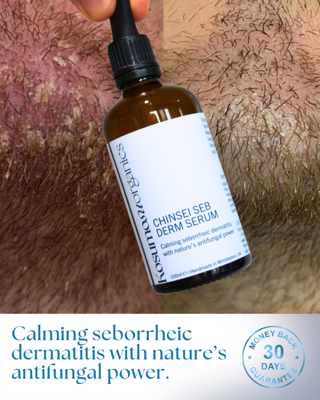 Chinsei Seb Derm Serum - 100ml (2+ Month Supply)